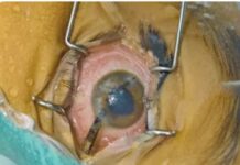 बच्चे की आंख पुतली में आर-पार हुए कांटे को डाक्टर्स की टीम ने निकाला