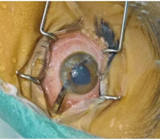 बच्चे की आंख पुतली में आर-पार हुए कांटे को डाक्टर्स की टीम ने निकाला